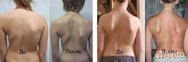 Массаж при сколиозе. Мануал и остеопатия