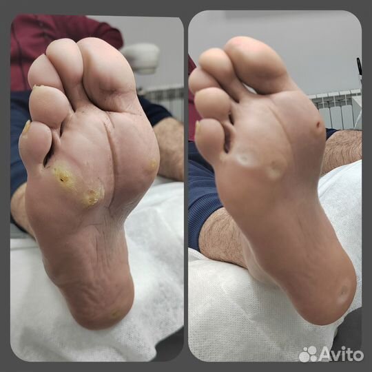 Подолог.Маникюр,Педикюр:неправильный ноготь,мозоли