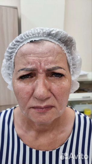 Релатокс, Ботокс