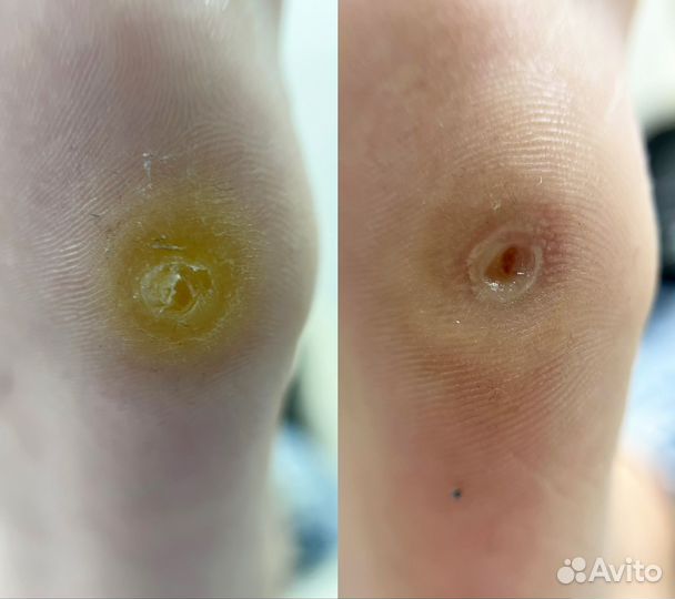 Курсы педикюра подология