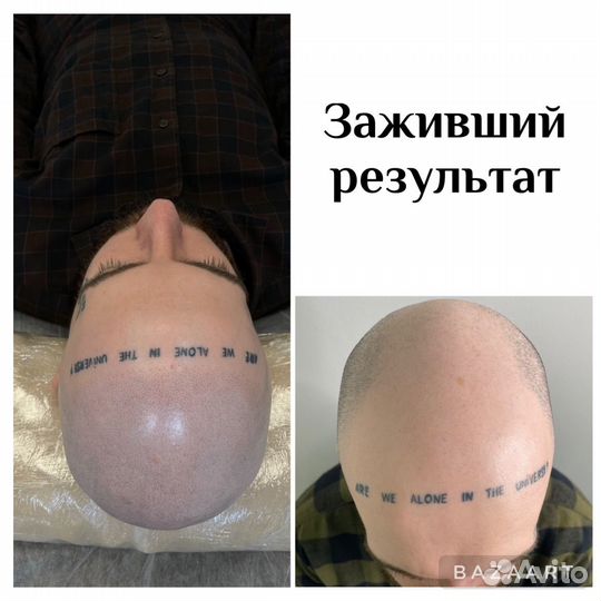 Трихопигментация головы, метод SMP