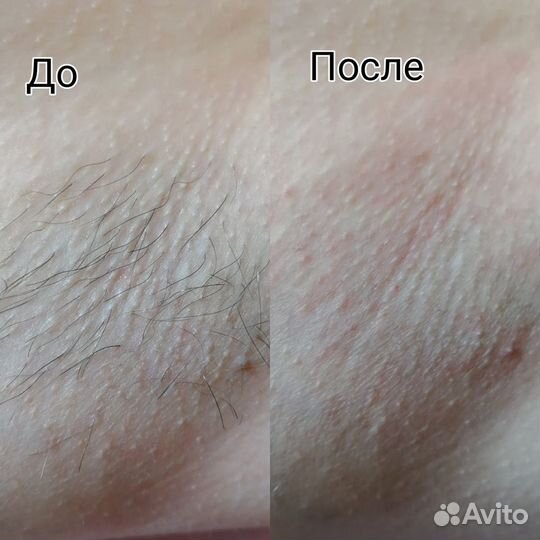 Шугаринг, ваксинг, парафинка, депиляция