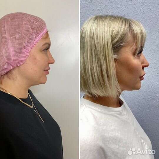 СМАС лифтинг