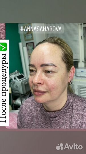 Карбоновый пилинг