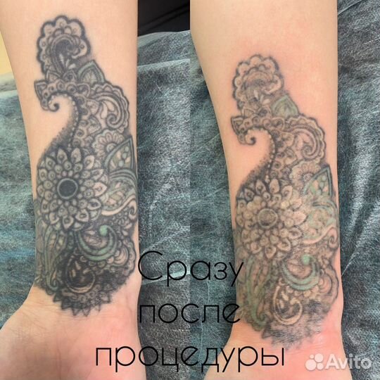 Лазерное удаление татуажа/тату. Карбоновый пилинг