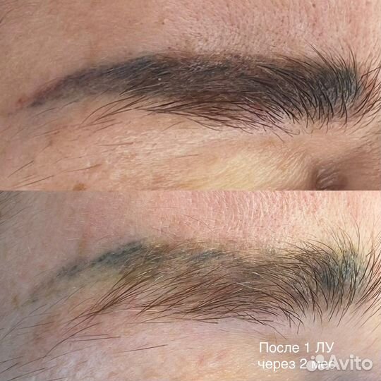 Удаление тату и татуажа лазером и ремувером