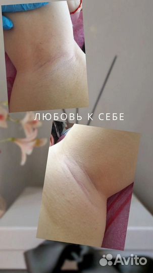 Лазерная эпиляция