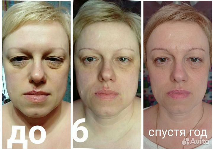 Витапластика