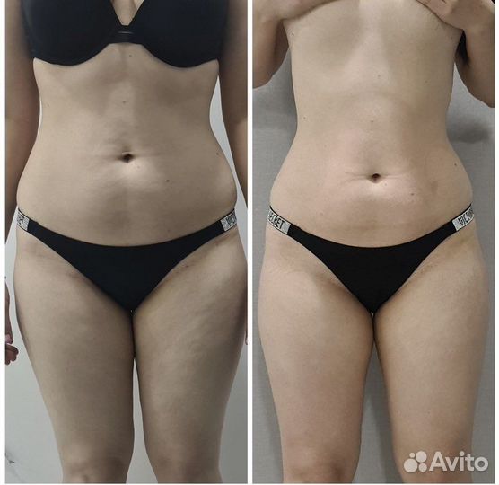 LPG массаж, жиротоп, вибро, антицеллюлитный массаж