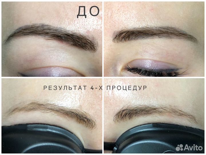 Удаление татуажа и тату