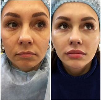 Тома Рязанцева Контурная пластика лица и тела 3дня